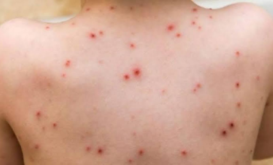 Cierra Michoacán con 231 casos positivos de sarampión en 2025